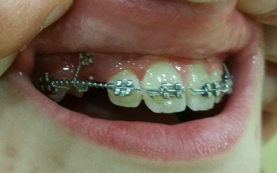 Caninos incluidos por vestibular 4