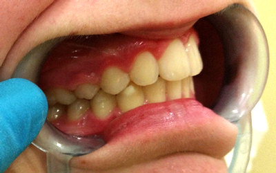 Desviacion línea media 4