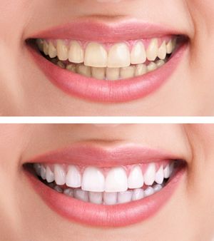 Estética dental
